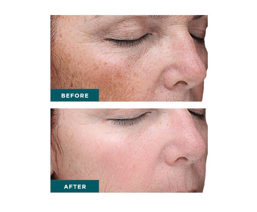 VI Chemical Peel
